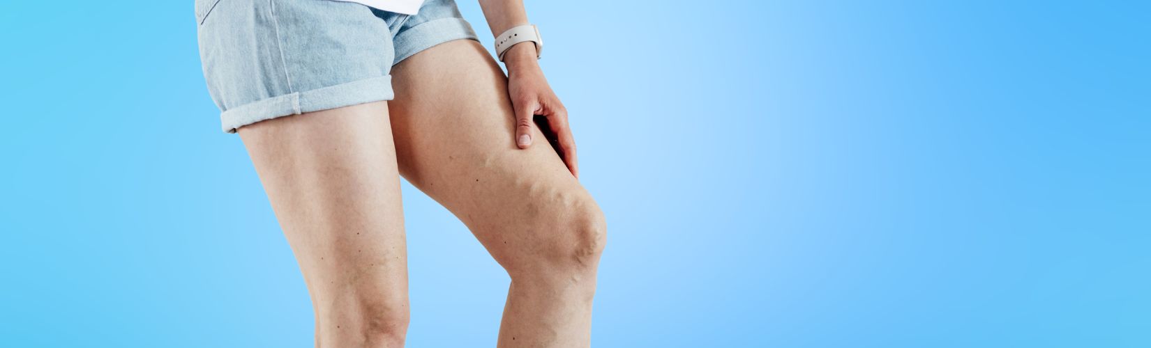 spider veins vs varicose veins 