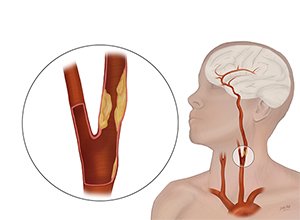 Carotid Artery Disease Visual